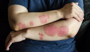 Dermatological skin disease. psoriasis, eczema, dermatitis, allergies. Skin lesions on the elbows. (1)