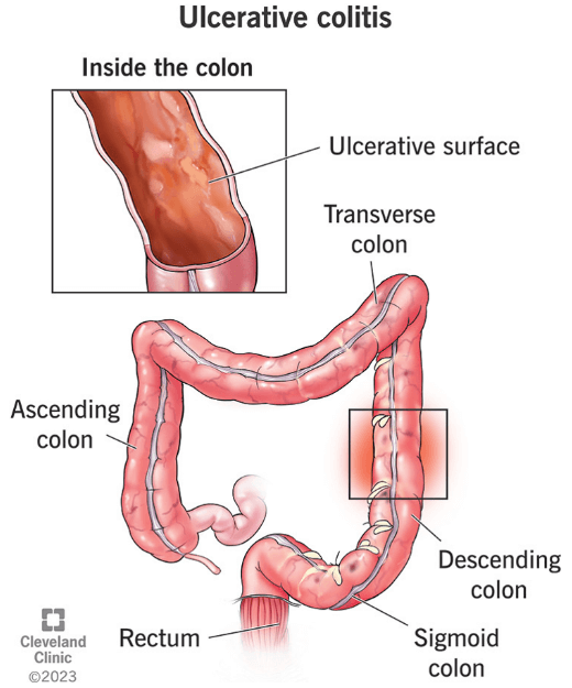 colon in ulcerative colitis